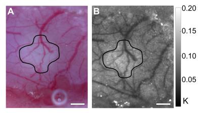 Webcam-based hospital-grade laser-speckle blood-flow imager is low in cost