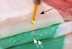 A chitosan patch infused with indocyanine green (ICG) dye wraps a rabbit carotid artery. A linear cut is repaired (white arrows) in laser-assisted vascular repair (LAVR). Laser spots (white arrowheads) are delivered by a 300 micron optical fiber (black arrow). (Image credit: SPIE Newsroom) A chitosan patch infused with indocyanine green (ICG) dye wraps a rabbit carotid artery. A linear cut is repaired (white arrows) in laser-assisted vascular repair (LAVR). Laser spots (white arrowheads) are delivered by a 300 micron optical fiber (black arrow). (Image credit: SPIE Newsroom)