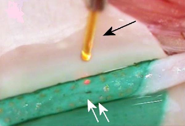 A chitosan patch infused with indocyanine green (ICG) dye wraps a rabbit carotid artery. A linear cut is repaired (white arrows) in laser-assisted vascular repair (LAVR). Laser spots (white arrowheads) are delivered by a 300 micron optical fiber (black arrow). (Image credit: SPIE Newsroom)
