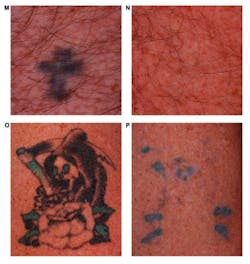 Multicolor tattoos are shown before (M, O) and after (N, P) treatment with a dual-wavelength Nd:YAG laser. Black inks are removed extremely well, but some blue and green inks remain.