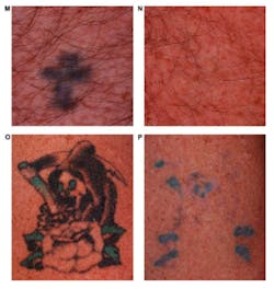 Multicolor tattoos are shown before (M, O) and after (N, P) treatment with a dual-wavelength Nd:YAG laser. Black inks are removed extremely well, but some blue and green inks remain. Multicolor tattoos are shown before (M, O) and after (N, P) treatment with a dual-wavelength Nd:YAG laser. Black inks are removed extremely well, but some blue and green inks remain.