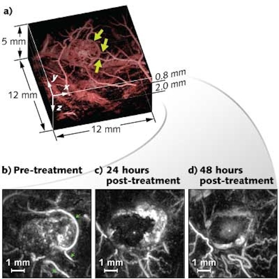 Photoacoustic imaging clearly identifies changes in blood vessels that feed a cancer tumor after administration of a therapeutic vascular disruption agent. The technique penetrates tissue to depths of 10 mm.