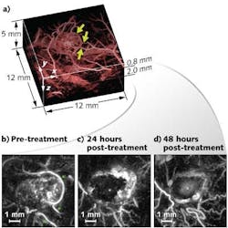 Photoacoustic imaging clearly identifies changes in blood vessels that feed a cancer tumor after administration of a therapeutic vascular disruption agent. The technique penetrates tissue to depths of 10 mm. Photoacoustic imaging clearly identifies changes in blood vessels that feed a cancer tumor after administration of a therapeutic vascular disruption agent. The technique penetrates tissue to depths of 10 mm.