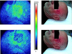 Laser speckle imaging (LSI) now provides real-time monitoring of blood photocoagulation in response to laser therapy of port wine stain (PWS) birthmarks. Actual images (right) and speckle flow imaging (SFI) diagrams (left) from the real-time video feed show an adult male before (upper) and after (lower) treatment on the left temple using a 585 nm pulsed-dye laser. The treatment showed a 37% improvement according to the SFI diagram.