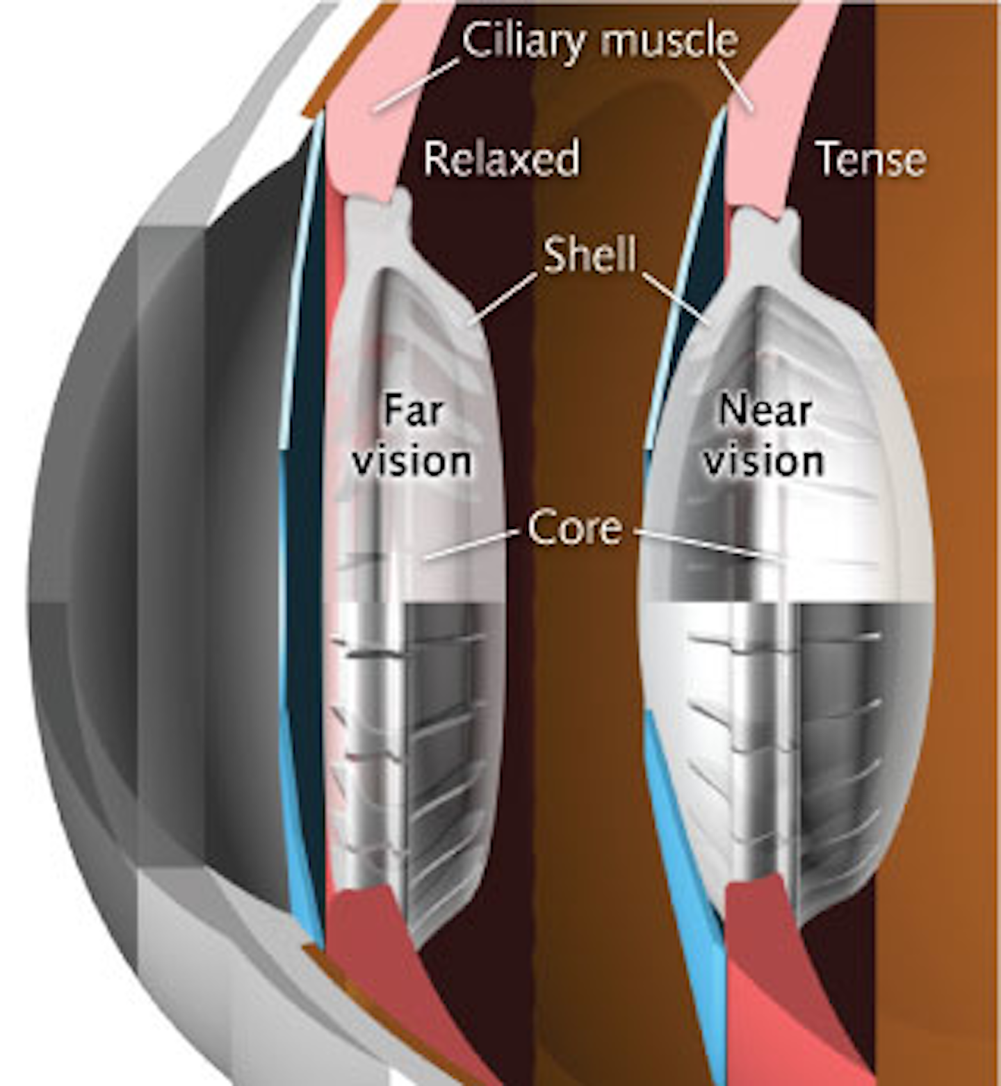 Ophthalmology Advances Bioinspired intraocular lens mimics natural