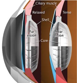 The biolnic bio-inspired intraocular lens (IOL) adjusts vision both near and far like the flexible lens in the human eye. The biolnic bio-inspired intraocular lens (IOL) adjusts vision both near and far like the flexible lens in the human eye.