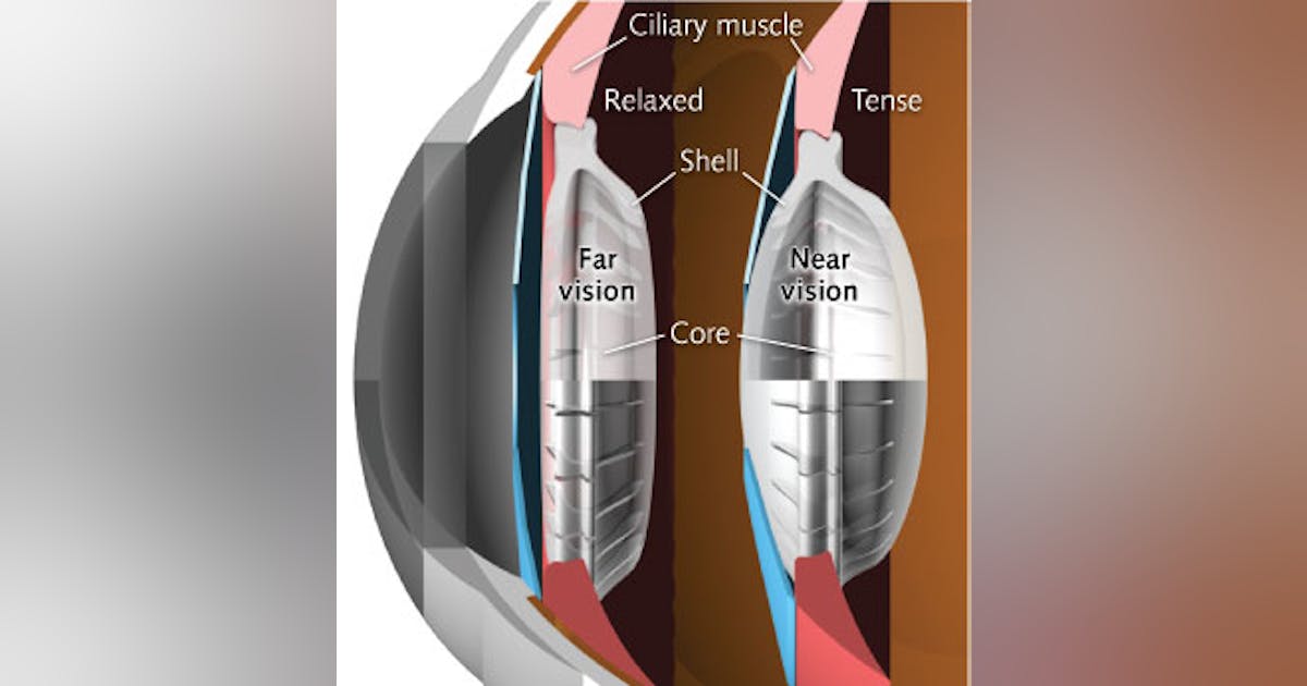 Ophthalmology Advances: Bio-inspired intraocular lens mimics natural ...