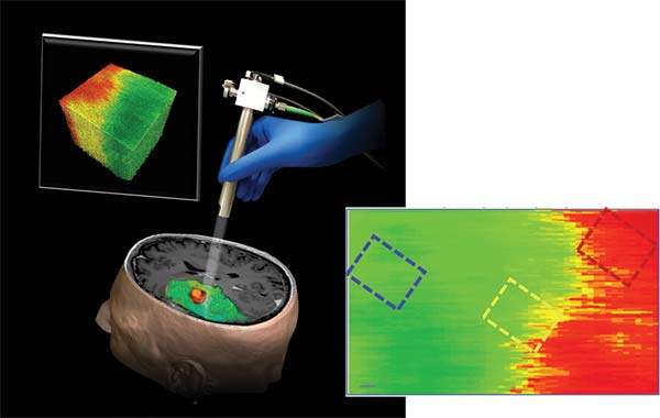 OCT produces a color-coded map (cancer in red, healthy tissue in green; inset) intraoperatively in real time.