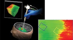 OCT produces a color-coded map (cancer in red, healthy tissue in green; inset) intraoperatively in real time. OCT produces a color-coded map (cancer in red, healthy tissue in green; inset) intraoperatively in real time.