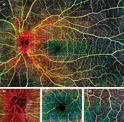 FIGURE 2. (a) Wide-field imagery of the retinal vasculature of a healthy young woman was obtained by montage scanning protocol of optical microangiography (OMAG). Data are coded with different colors for each of three layers: red represents NFL, green is SRL, and blue is DRL. (b-d) exhibit the magnified angiograms located in the white dashed boxes in (a), which better illustrates the high sensitivity of OMAG. OMAG angiograms corresponding to the white dashed boxes in (b) are shown in (b-d), magnified to demonstrate the detail of blood vessels in different regions, including (b) optic nerve head, (c) fovea, and (d) temporal region. The size of (a) is 12 &times; 16 mm2, while the size of (b-d) is 2.0 &times; 2.4 mm2.