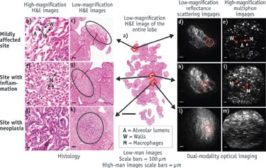 FIGURE 5. Ex vivo images of unstained tumor-laden mouse lung tissue. Three different sites were imaged as indicated in (a). Two left columns are high- and low-magnification H&amp;E images. Two right columns are low-magnification (reflection/scattering) and high-magnification (multiphoton) images. Images in each row are acquired from the same site. The red circles in low-magnification reflectance images indicate the approximate location of the site from which the multiphoton images are obtained.