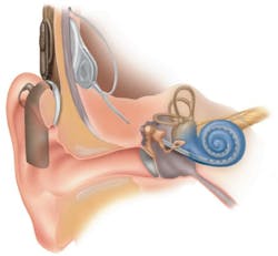 Lzh 120419 Cochlea Implantat Ef Rh 450width Lzh 120419 Cochlea Implantat Ef Rh 450width