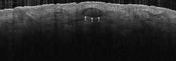 Nodular Bcc Web Nodular Bcc Web