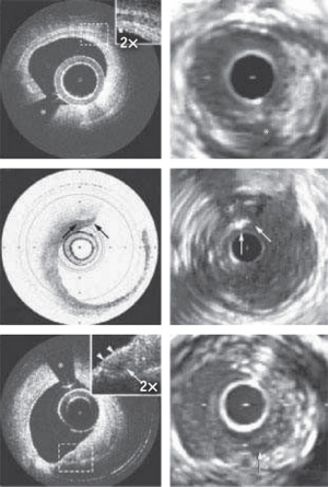 FIGURE 1. Comparing OCT (left) and intravenous ultrasound (IVUS) imagery of the same artery demonstrates the vast difference in resolution.