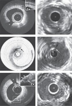 FIGURE 1. Comparing OCT (left) and intravenous ultrasound (IVUS) imagery of the same artery demonstrates the vast difference in resolution. FIGURE 1. Comparing OCT (left) and intravenous ultrasound (IVUS) imagery of the same artery demonstrates the vast difference in resolution.