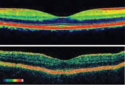 FIGURE 2. Fourier domain (bottom) provides a higher resolution than time domain (top) OCT, but the biggest difference between the two approaches is speed. FIGURE 2. Fourier domain (bottom) provides a higher resolution than time domain (top) OCT, but the biggest difference between the two approaches is speed.