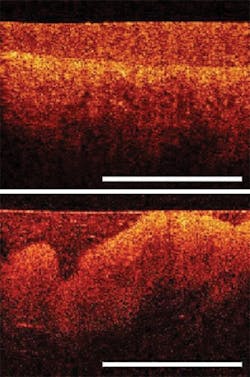 FIGURE 2. New OCT applications include noninvasive 'optical biopsy' of reproductive organs. The Niris OCT system from Imalux enables imaging of the cervix, and highlights the differences in normal cervical tissue (top) and tissue affected by structural changes due to a cervical wart (bottom). FIGURE 2. New OCT applications include noninvasive 'optical biopsy' of reproductive organs. The Niris OCT system from Imalux enables imaging of the cervix, and highlights the differences in normal cervical tissue (top) and tissue affected by structural changes due to a cervical wart (bottom).