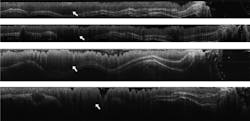 FIGURE 2. A sequence of OCT images–each taken about six weeks apart, with time moving ahead from top to bottom–shows the development of a tumor (dark area to the left of the white arrows) in the colon of a mouse, which was treated with a carcinogen. FIGURE 2. A sequence of OCT images–each taken about six weeks apart, with time moving ahead from top to bottom–shows the development of a tumor (dark area to the left of the white arrows) in the colon of a mouse, which was treated with a carcinogen.