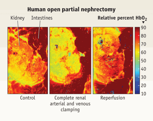 FIGURE 1. Hyperspectral imaging provides a quantitative measure of blood flow to tissue. In the case of kidney surgery, clinicians can monitor tissue oxygenation levels and move more quickly if the tissue becomes at risk for damage (red pixels correspond with high levels of oxygenation while greens and blues correspond with low levels). Imaged at rest (left), and later during surgery, when renal arterial and venous occlusion occurred, a kidney exhibits a decrease in tissue oxygenation (center). Once blood flow to the kidney is restored, the percentage of oxyhemoglobin normalizes (right).