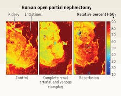 FIGURE 1. Hyperspectral imaging provides a quantitative measure of blood flow to tissue. In the case of kidney surgery, clinicians can monitor tissue oxygenation levels and move more quickly if the tissue becomes at risk for damage (red pixels correspond with high levels of oxygenation while greens and blues correspond with low levels). Imaged at rest (left), and later during surgery, when renal arterial and venous occlusion occurred, a kidney exhibits a decrease in tissue oxygenation (center). Once blood flow to the kidney is restored, the percentage of oxyhemoglobin normalizes (right). FIGURE 1. Hyperspectral imaging provides a quantitative measure of blood flow to tissue. In the case of kidney surgery, clinicians can monitor tissue oxygenation levels and move more quickly if the tissue becomes at risk for damage (red pixels correspond with high levels of oxygenation while greens and blues correspond with low levels). Imaged at rest (left), and later during surgery, when renal arterial and venous occlusion occurred, a kidney exhibits a decrease in tissue oxygenation (center). Once blood flow to the kidney is restored, the percentage of oxyhemoglobin normalizes (right).