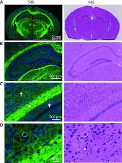 The same areas of brain, imaged with SRS microscopy (left) and conventional H&E staining (right), which is the current technique used to diagnose brain tumors at the tissue level. The research suggests that SRS microscopy could be as accurate as H&E staining in allowing doctors to see tumors, without having to remove tissue or inject dyes into the patient. The same areas of brain, imaged with SRS microscopy (left) and conventional H&E staining (right), which is the current technique used to diagnose brain tumors at the tissue level. The research suggests that SRS microscopy could be as accurate as H&E staining in allowing doctors to see tumors, without having to remove tissue or inject dyes into the patient.