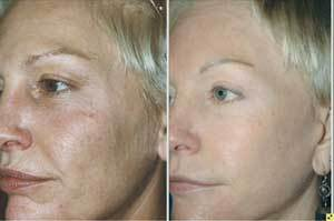 Th 0708ilsrejuvenat01