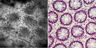 FIGURE 1. The OptiScan confocal endomicroscopy system was used to collect a single optical section of the human descending colon in vivo following intravenous administration of fluorescein sodium (left). The image (500 &micro;m field of view) shows well-defined and ordered crypts projecting onto the surface of the colonic mucosa. A corresponding histology image was collected en face from a biopsy section of tissue 6 &micro;m thick (right).
