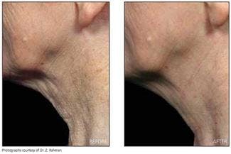 The Reliant Fraxel re:pair is a CO2 laser ablative skin-resurfacing system capable of treating fine lines, deep furrows, brown spots, acne scarring, and darker skin types at depths from 300 &micro;m to 1.6 mm into the dermis (on and off the face), all in a single handpiece.