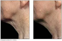 The Reliant Fraxel re:pair is a CO2 laser ablative skin-resurfacing system capable of treating fine lines, deep furrows, brown spots, acne scarring, and darker skin types at depths from 300 µm to 1.6 mm into the dermis (on and off the face), all in a single handpiece. The Reliant Fraxel re:pair is a CO2 laser ablative skin-resurfacing system capable of treating fine lines, deep furrows, brown spots, acne scarring, and darker skin types at depths from 300 µm to 1.6 mm into the dermis (on and off the face), all in a single handpiece.