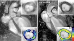 Figure 2. This MRI/optical image shows a mouse heart before (left) and 48 hours after (right) injection of a probe developed to detect vascular cell adhesion molecule-1 (VCAM-1) expression in experimental atherosclerosis in vivo. The dotted lines depict location of short-axis view (insets). Figure 2. This MRI/optical image shows a mouse heart before (left) and 48 hours after (right) injection of a probe developed to detect vascular cell adhesion molecule-1 (VCAM-1) expression in experimental atherosclerosis in vivo. The dotted lines depict location of short-axis view (insets).