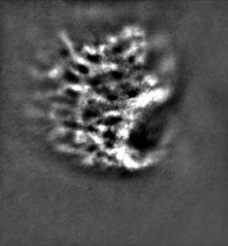 Figure 5. The lamina cribrosa is shown deep inside the optic-nerve hole. Figure 5. The lamina cribrosa is shown deep inside the optic-nerve hole.