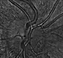 Figure 6. This mosaic shows the entire papilla of a healthy eye. The image represents an area of approximately 2 × 2 mm at a resolution of approximately 3 µm. Figure 6. This mosaic shows the entire papilla of a healthy eye. The image represents an area of approximately 2 × 2 mm at a resolution of approximately 3 µm.