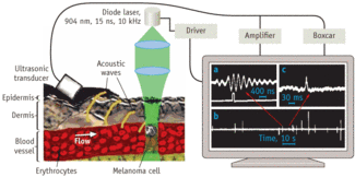 FIGURE 1. In vivo photoacoustic flow cytometry uses a diode laser to detect individual cells, either without labels or using gold nanoparticle labels, in blood and lymph flow or in sentinel lymph nodes (left). Results are derived from the photoacoustic signal (upper trace) and boxcar gate (lower trace; a), and compressed photoacoustic signals from single melanoma cells (b). Averaging 36 signals from one melanoma cell produces a composite reading (c). The clinical prototype system uses optical fiber to deliver laser radiation to vessels in the wrist, and a focused cylindrical ultrasound transducer.