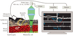 FIGURE 1. In vivo photoacoustic flow cytometry uses a diode laser to detect individual cells, either without labels or using gold nanoparticle labels, in blood and lymph flow or in sentinel lymph nodes (left). Results are derived from the photoacoustic signal (upper trace) and boxcar gate (lower trace; a), and compressed photoacoustic signals from single melanoma cells (b). Averaging 36 signals from one melanoma cell produces a composite reading (c). The clinical prototype system uses optical fiber to deliver laser radiation to vessels in the wrist, and a focused cylindrical ultrasound transducer. FIGURE 1. In vivo photoacoustic flow cytometry uses a diode laser to detect individual cells, either without labels or using gold nanoparticle labels, in blood and lymph flow or in sentinel lymph nodes (left). Results are derived from the photoacoustic signal (upper trace) and boxcar gate (lower trace; a), and compressed photoacoustic signals from single melanoma cells (b). Averaging 36 signals from one melanoma cell produces a composite reading (c). The clinical prototype system uses optical fiber to deliver laser radiation to vessels in the wrist, and a focused cylindrical ultrasound transducer.