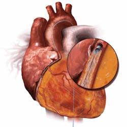 Th Excimer 1109 01 Th Excimer 1109 01