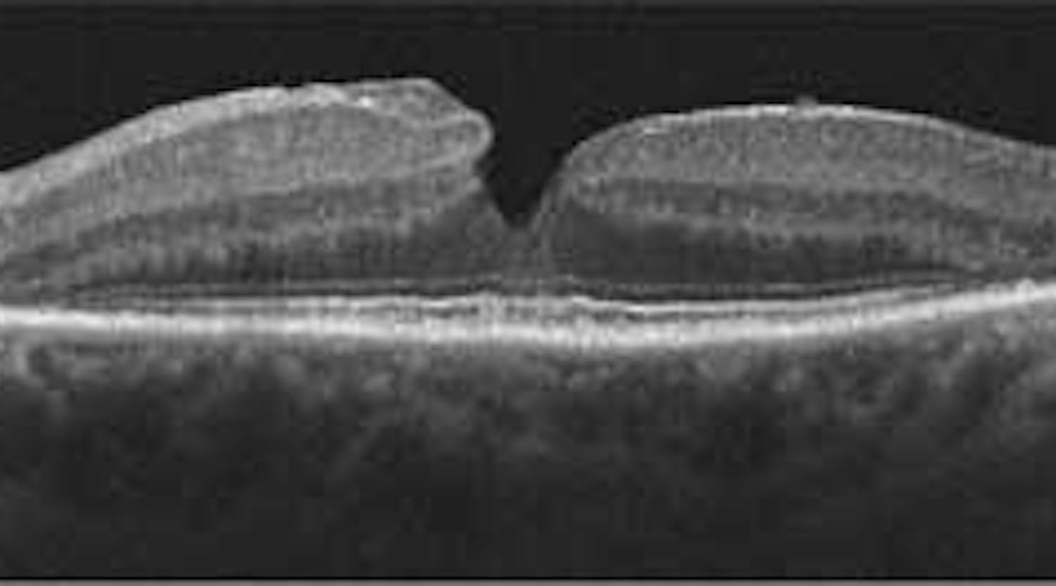 ARVO/ISIE explored advanced uses of OCT imaging of the eyes.
