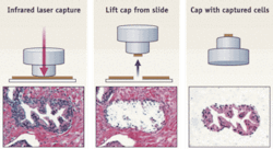FIGURE 1. The original laser-capture microdissection approach uses an infrared laser to activate the EVA polymer placed on top of the target cells (left). The cap with the EVA polymer is removed from the tissue section (center), taking with it the captured cells (right), from which biomolecules can be extracted. FIGURE 1. The original laser-capture microdissection approach uses an infrared laser to activate the EVA polymer placed on top of the target cells (left). The cap with the EVA polymer is removed from the tissue section (center), taking with it the captured cells (right), from which biomolecules can be extracted.