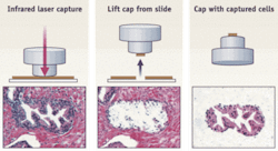 FIGURE 1. The original laser-capture microdissection approach uses an infrared laser to activate the EVA polymer placed on top of the target cells (left). The cap with the EVA polymer is removed from the tissue section (center), taking with it the captured cells (right), from which biomolecules can be extracted. FIGURE 1. The original laser-capture microdissection approach uses an infrared laser to activate the EVA polymer placed on top of the target cells (left). The cap with the EVA polymer is removed from the tissue section (center), taking with it the captured cells (right), from which biomolecules can be extracted.