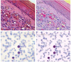 Figure 3. A histopathology section from a Kaposi’s sarcoma was taken with the miniature objective shown in Fig. 2c (top, left) and with a Zeiss 40x, NA=0.95 objective (top, right). An image of Giemsa-stained blood smear, positive for malaria, was taken with a miniature microscope (bottom, left) and Zeiss 40x, NA=0.95 objective (bottom, right). Figure 3. A histopathology section from a Kaposi’s sarcoma was taken with the miniature objective shown in Fig. 2c (top, left) and with a Zeiss 40x, NA=0.95 objective (top, right). An image of Giemsa-stained blood smear, positive for malaria, was taken with a miniature microscope (bottom, left) and Zeiss 40x, NA=0.95 objective (bottom, right).