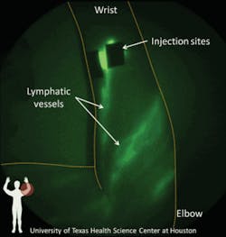 FIGURE 1. Using the near-infrared fluorophore indocyanine green, researchers at The University of Texas Health Science Center-Houston can image the human lymphatic system. In this case, six intradermal injections of 25 &micro;g ICG in 100 &micro;L of saline highlight lymphatic vessels in a patient&rsquo;s arm.