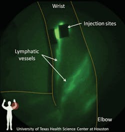 FIGURE 1. Using the near-infrared fluorophore indocyanine green, researchers at The University of Texas Health Science Center-Houston can image the human lymphatic system. In this case, six intradermal injections of 25 µg ICG in 100 µL of saline highlight lymphatic vessels in a patient’s arm. FIGURE 1. Using the near-infrared fluorophore indocyanine green, researchers at The University of Texas Health Science Center-Houston can image the human lymphatic system. In this case, six intradermal injections of 25 µg ICG in 100 µL of saline highlight lymphatic vessels in a patient’s arm.