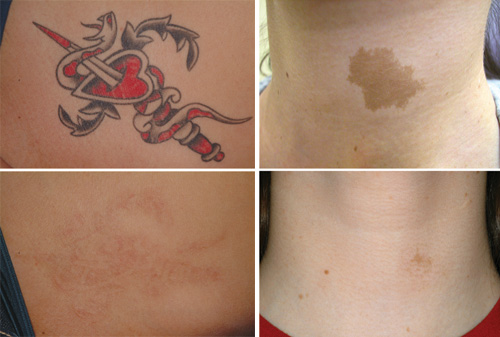 FIGURE 1. Before (top) and after (bottom) images illustrate how the Alex TriVantage&mdash;which emits 532, 755, and 1064 nm laser light&mdash;removes tattoos (left; courtesy of Dr. G. Goldberg) and treats pigment lesions (right; courtesy of S. Kilmer).