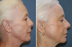 FIGURE 2. Nonablative fractional mode laser treatments use pulsed CO2 lasers to resurface wrinkled skin (top; courtesy of Dr. R. Bushman) and restore texture to burned skin (bottom; courtesy of Dr. J. Waibel).