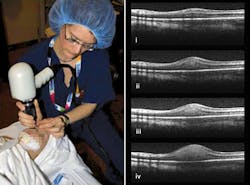 FIGURE 2. A 3 lb handheld OCT scanner developed by Bioptigen (Raleigh, NC) scans the retina of a premature infant at the Hospital for Sick Children (Toronto, ON, Canada), producing cross-sectional images showing pediatric retinoblastoma (eye cancer). FIGURE 2. A 3 lb handheld OCT scanner developed by Bioptigen (Raleigh, NC) scans the retina of a premature infant at the Hospital for Sick Children (Toronto, ON, Canada), producing cross-sectional images showing pediatric retinoblastoma (eye cancer).