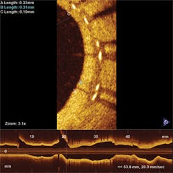 FIGURE 3. An OCT cross-section of an artery shows how the arterial wall has healed around a half-dozen stents (bright spots). The dark area is the interior of the artery through which blood flows. FIGURE 3. An OCT cross-section of an artery shows how the arterial wall has healed around a half-dozen stents (bright spots). The dark area is the interior of the artery through which blood flows.