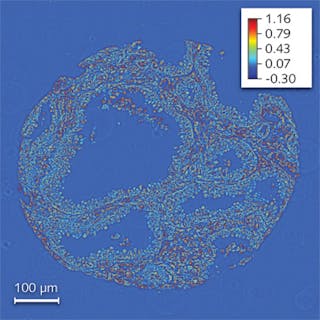 FIGURE 1. A quantitative phase image of a prostate biopsy is stitched together from 100 (10 &times; 10) smaller field-of-view images. The quantitative data is indicated in different colors with red being a long optical path length and blue being a short optical path length. The color bar indicates phase shift in radians. The data show that the basal cell layer is clearly visible in the high-grade prostatic intraepithelial neoplasia (HGPIN) cores.