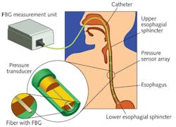 FIGURE 3. A DTG-based fiber-optic pressure sensor monitors operation of the human esophagus.