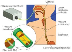FIGURE 3. A DTG-based fiber-optic pressure sensor monitors operation of the human esophagus. FIGURE 3. A DTG-based fiber-optic pressure sensor monitors operation of the human esophagus.