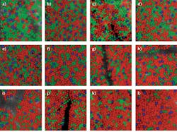 FIGURE 2. Images of parts of the retina from 10 patients, showing wide differences in the distributions of red, green, and blue receptors, illustrated with false color.