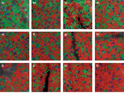 FIGURE 2. Images of parts of the retina from 10 patients, showing wide differences in the distributions of red, green, and blue receptors, illustrated with false color. FIGURE 2. Images of parts of the retina from 10 patients, showing wide differences in the distributions of red, green, and blue receptors, illustrated with false color.